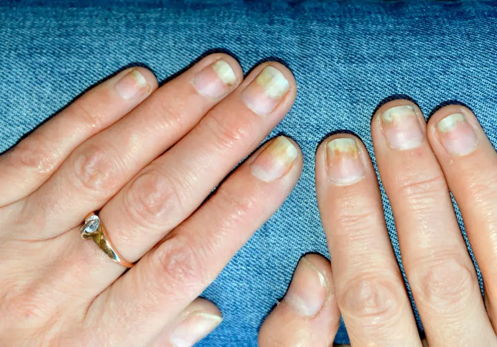 Jak usunąć przebarwienia na hybrydzie i cieszyć się idealnym manicure