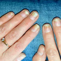 Jak usunąć przebarwienia na hybrydzie i cieszyć się idealnym manicure